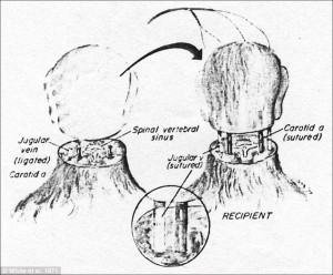 human head transplantation